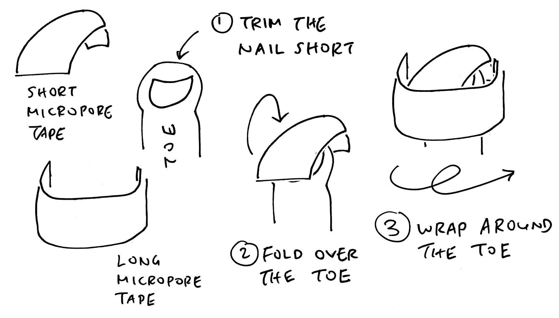 Wrapping injured toes in Micropore Tape